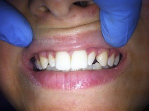 реставрация зубов фото