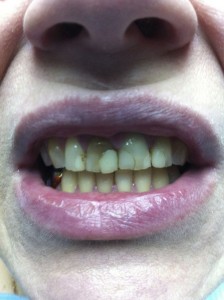 реставрация зубов фото