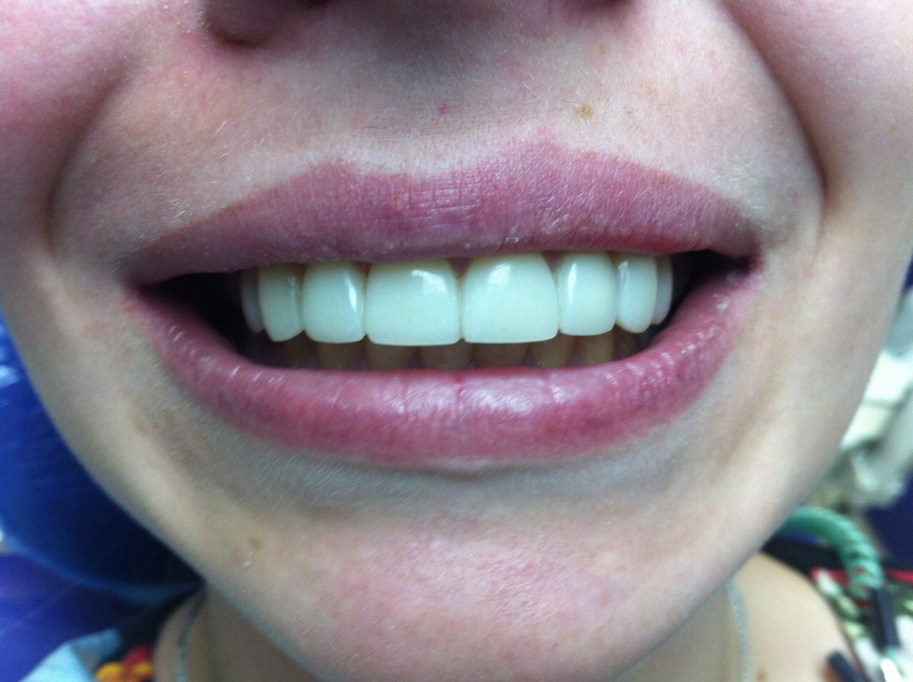 зубы после реставрации