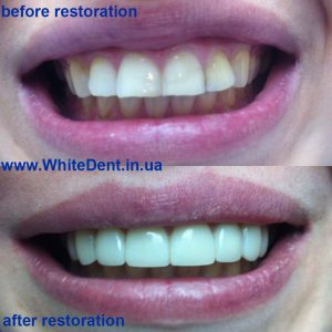 Реставрация зубов в широком и узком смысле. В чем отличие?