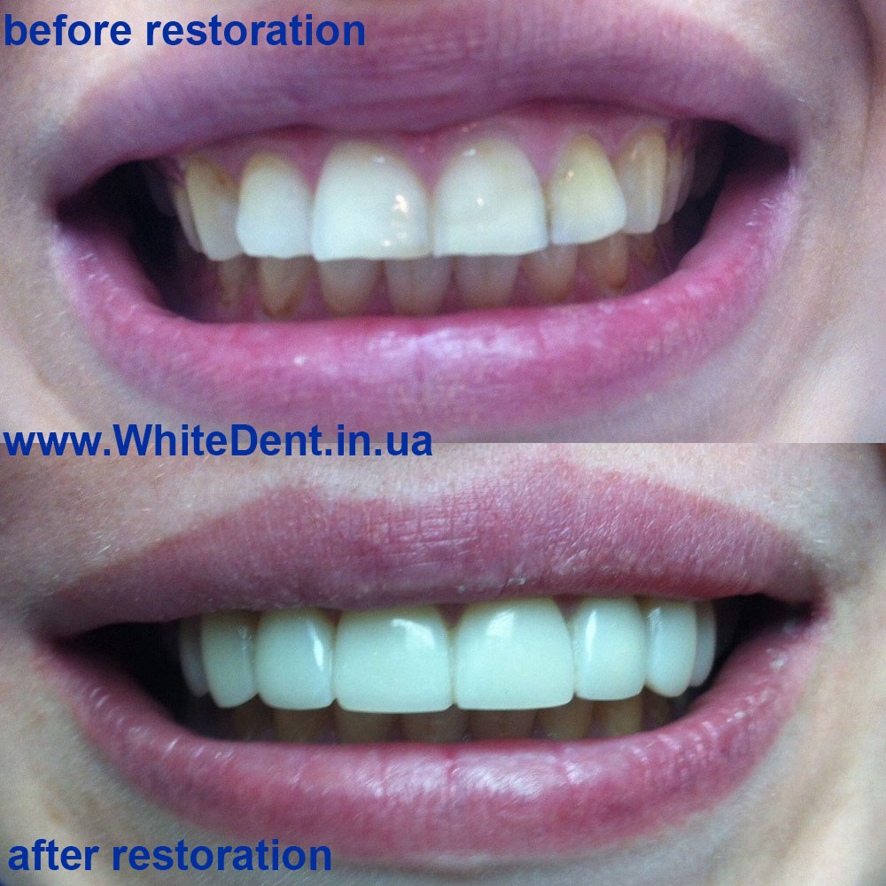 зубы до и после реставрации