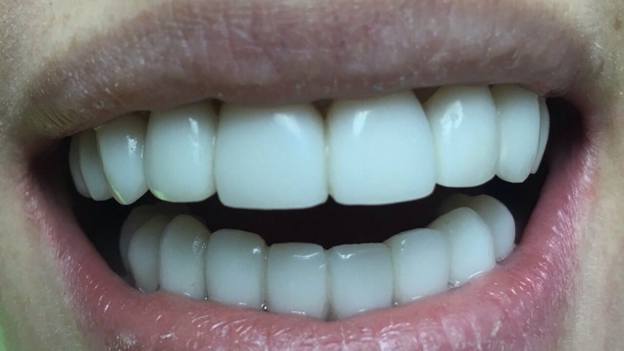 Реставрация зубов Днепре