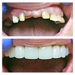 Реставрация зубов в Днепре