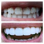 Реставрация зубов в Днепре